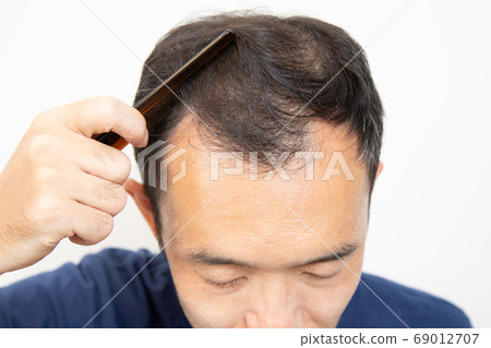 Middle aged man suffering thin hair Middle aged man suffering thin hair 69012707