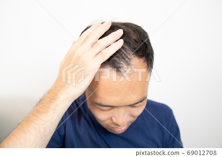中年男子遭受稀薄的頭髮 69012708