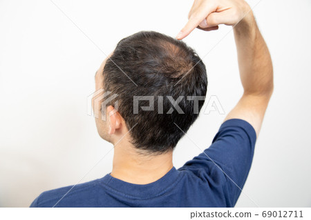 中年男子遭受稀薄的頭髮 69012711