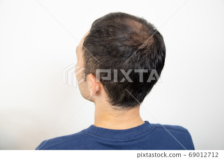 中年男子遭受稀薄的頭髮 69012712