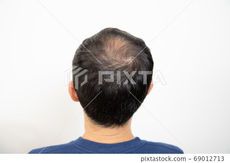 中年男子遭受稀薄的頭髮 69012713