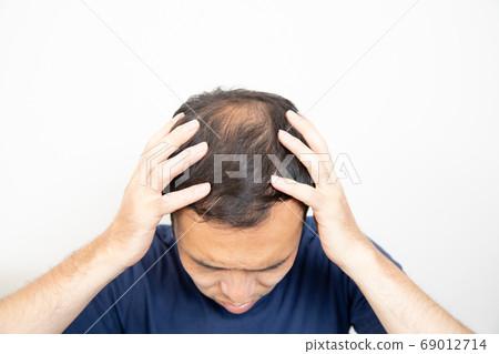 Middle aged man suffering thin hair 69012714