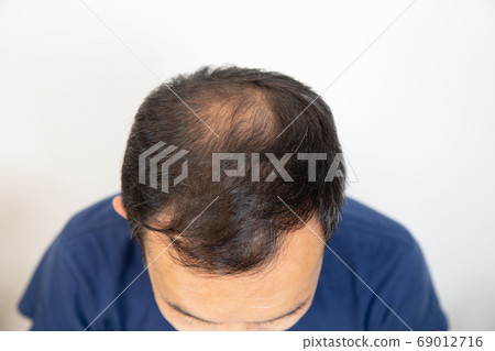 中年男子遭受稀薄的頭髮 69012716