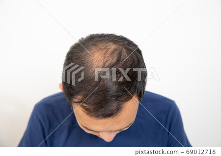 Middle aged man suffering thin hair Middle aged man suffering thin hair 69012718