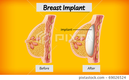Anatomy of human breast implant Anatomy of human breast implant 69026524