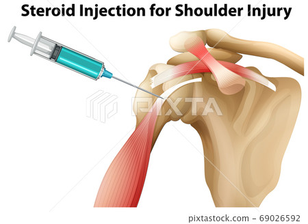 Steroid Injection for Shoulder Injury Steroid Injection for Shoulder Injury 69026592