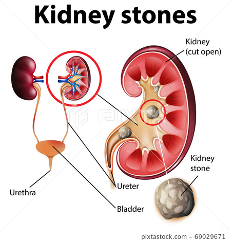Informative illustration of kidney stones Informative illustration of kidney stones 69029671