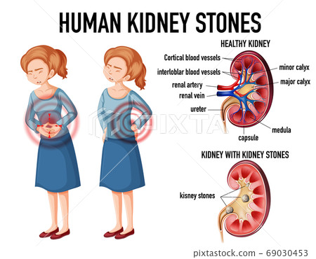 Comparison of healthy kidney and kidney with Comparison of healthy kidney and kidney with 69030453