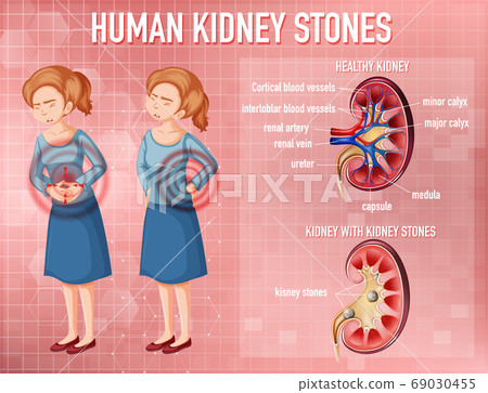 Comparison of healthy kidney and kidney with Comparison of healthy kidney and kidney with 69030455
