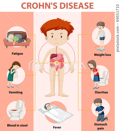 Medical infographic of Crohn's Disease Medical infographic of Crohn's Disease 69031710