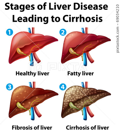 Stages of liver disease leading to Cirrhosis Stages of liver disease leading to Cirrhosis 69034210