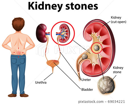 Comparison of healthy kidney and kidney with Comparison of healthy kidney and kidney with 69034221