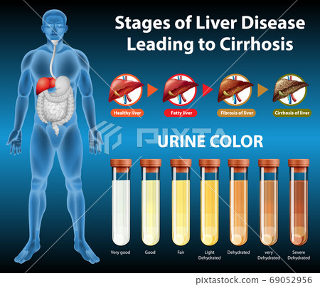 Stages of liver disease Stages of liver disease 69052956
