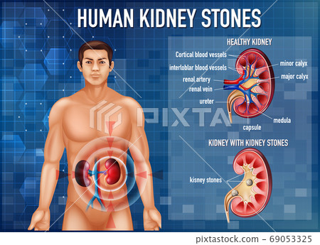 Informative illustration of kidney stones Informative illustration of kidney stones 69053325
