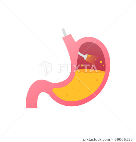 Stomach endoscopy. Endoscope in stomach through esophagus. Vector stock illustration. Stomach endoscopy. Endoscope in stomach through esophagus. Vector stock illustration. 69066153