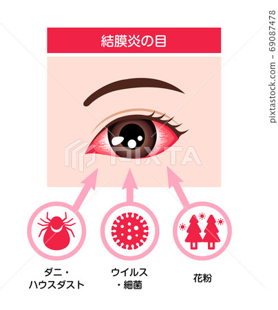 結膜炎的眼圖 結膜炎的原因 插圖素材 69087478 Pixta圖庫