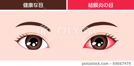 Comparative illustration of conjunctivitis and normal eyes Comparative illustration of conjunctivitis and normal eyes 69087479