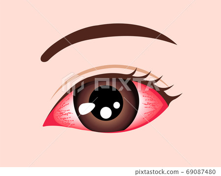 Conjunctivitis eye illustration (no letters) 69087480