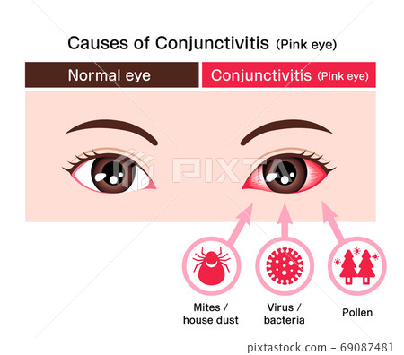 Illustration of comparative eyes with conjunctivitis (cause of conjunctivitis) / English Illustration of comparative eyes with conjunctivitis (cause of conjunctivitis) / English 69087481