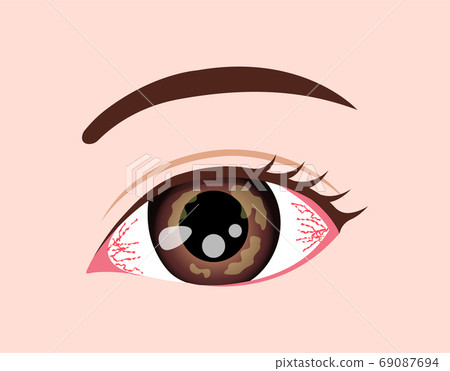 眼/眼疾病矢量圖(角膜皰疹) 眼/眼疾病矢量圖(角膜皰疹) 69087694