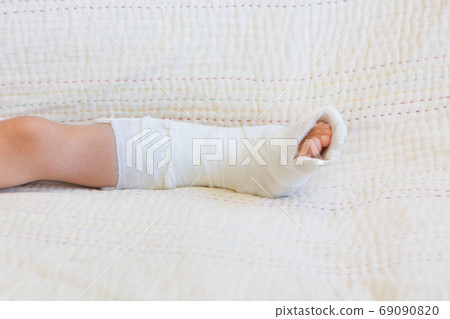 broken leg. Close-up of the cast on the feet. exercises to repair and strengthen muscles. damage to the bones. medical care of a surgeon in the emergency room 69090820