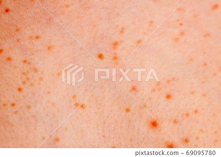 Close up image of a little boy's body suffering severe urticaria, nettle rash also called hives 69095780