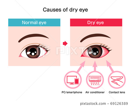 Dry Eyes/Thirst/Causes and Symptoms Illustration (English) 69126389