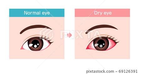 乾眼/口渴比較插圖（英語） 69126391
