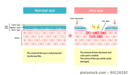 Dry eye and thirst surface cross-section illustration (English) 69126392