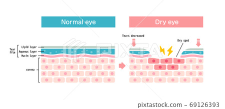 Dry eye and thirst surface cross-section illustration (English) 69126393