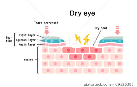 Illustration of a cross-sectional view of the surface of a dry eye (English) Illustration of a cross-sectional view of the surface of a dry eye (English) 69126395
