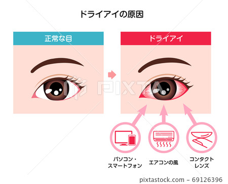 乾眼症,口渴/原因和症狀說明 乾眼症,口渴/原因和症狀說明 69126396