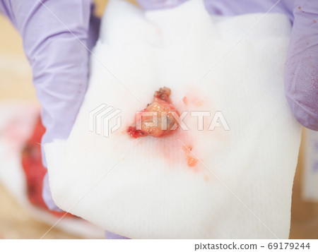 Breast cancer tumor resected Breast cancer tumor resected 69179244