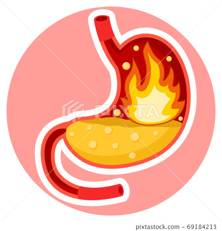 Heartburn Pictures