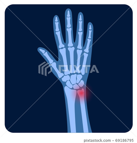 Fracture x ray concept Fracture x ray concept 69186795