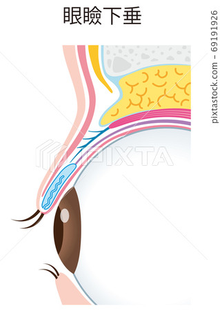 眼瞼下垂結構眼球截面 69191926