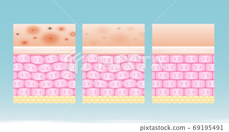 acne skin spot pimple problem vector design. - Stock Illustration ...