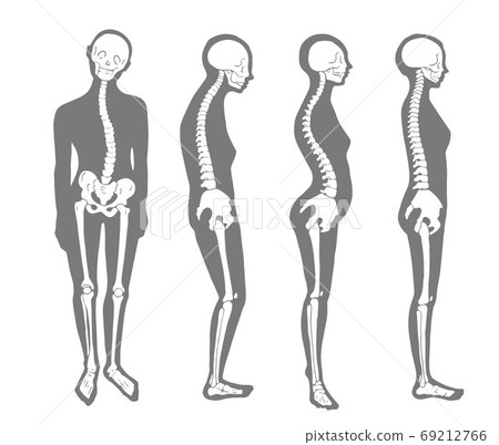 Male Skeleton Sample With Good And Bad Posture Stock Illustration -  Download Image Now - Bad Posture, Bone, Kyphosis - iStock