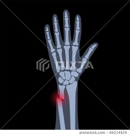 Fracture x ray concept 69214829