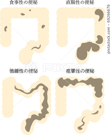 Constipation type illustration - Stock Illustration [69266676] - PIXTA