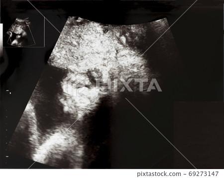 Echo picture of the fetus at 36 weeks of pregnancy 69273147