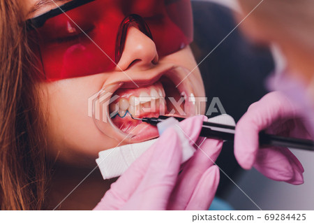 The dentist comparing patient's teeth shade with samples for bleaching treatment. 69284425