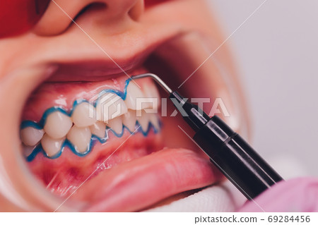 Close-up portrait of a female patient visiting dentist for teeth whitening in clinic,Teeth whitening procedure. 69284456