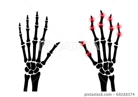 Arthrits x ray 69288374