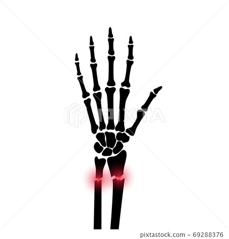 Fracture x ray concept Fracture x ray concept 69288376