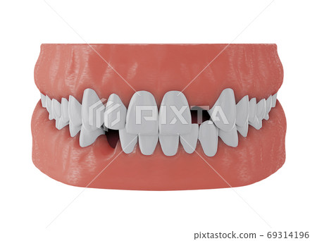 jaw with missing front upper tooth deuce and lower tooth three on white background, 3d render 69314196
