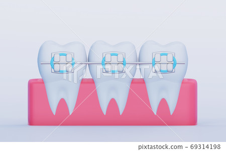 Three Teeth with Metal Braces in the gum. Care, Orthodontics and Dentistry symbols, 3D render Three Teeth with Metal Braces in the gum. Care, Orthodontics and Dentistry symbols, 3D render 69314198