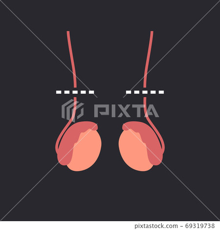 vasectomy flat icon, vector color line 69319738