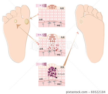 Illustration of the three major troubles of the foot, octopus, wolves and warts 69322184