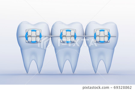 Three Teeth with Metal Braces. Care, Orthodontics and Dentistry symbols, 3D render Three Teeth with Metal Braces. Care, Orthodontics and Dentistry symbols, 3D render 69328862